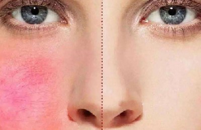 敏感肌